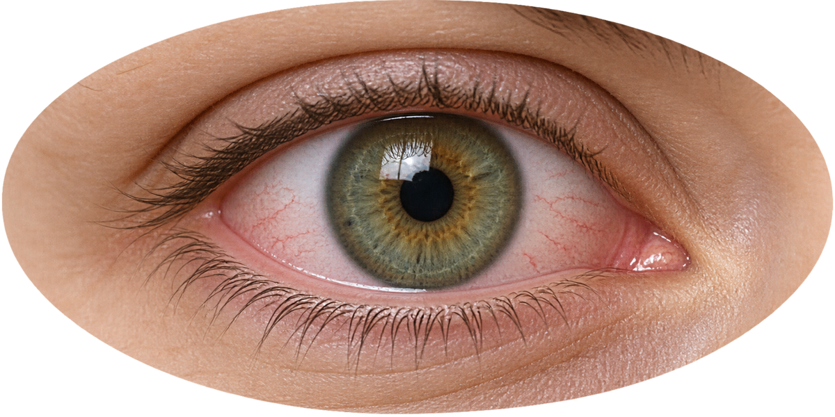 dry eye surface v2